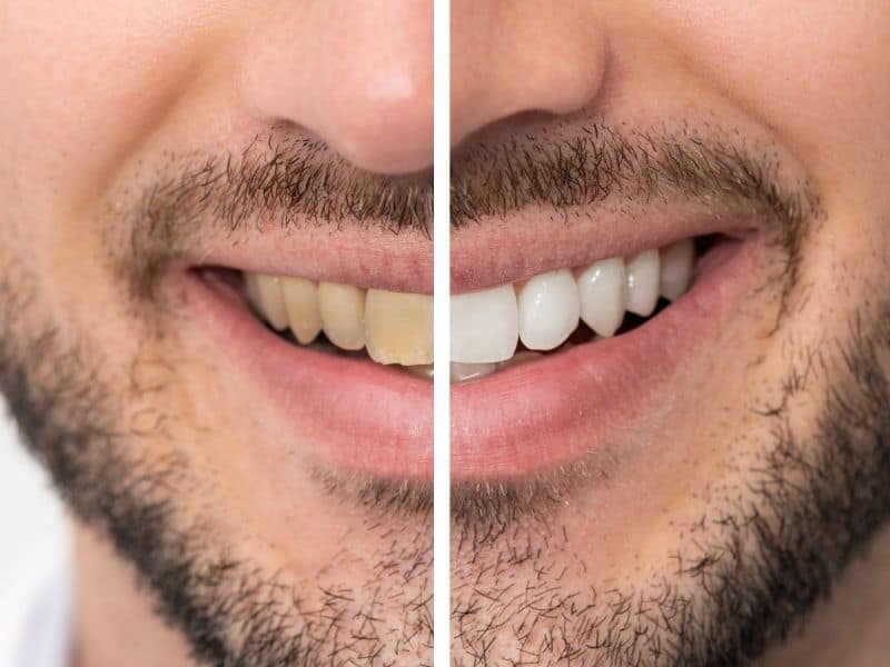 Split-image close-up of a man’s smile showing before-and-after teeth whitening results, with yellowed teeth on the left and brighter, whiter teeth on the right.