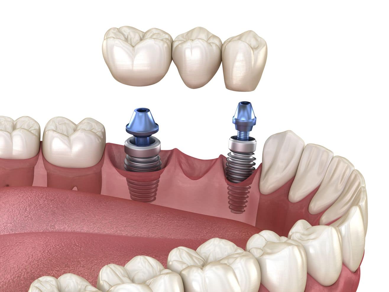 Dental bridges for missing teeth
