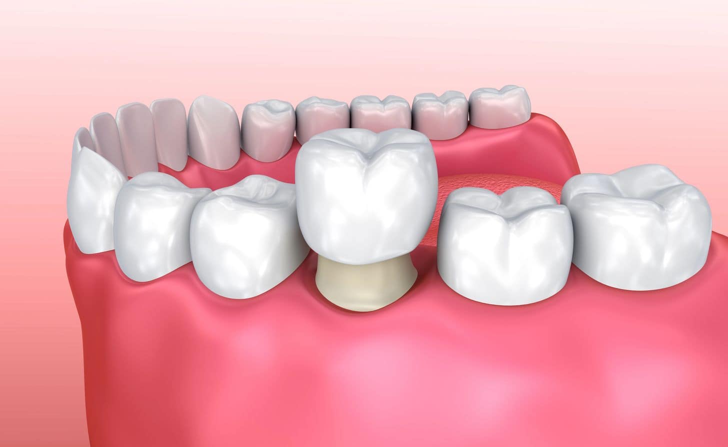 Dental crowns restoration