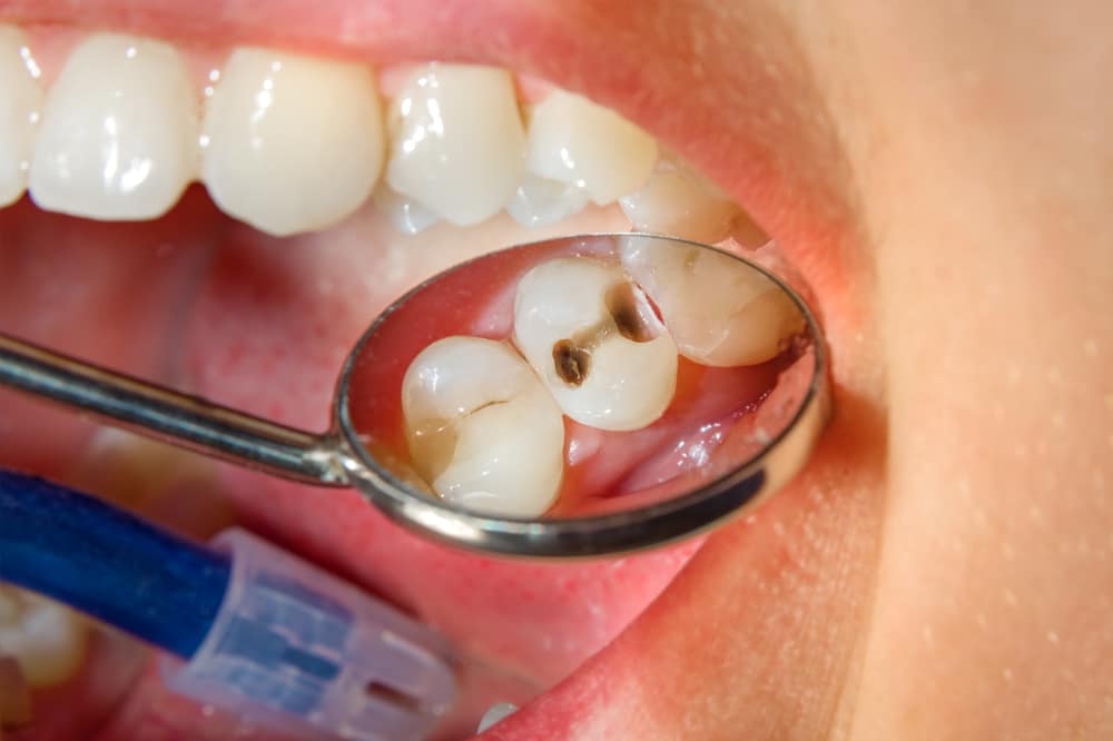 Porcelain tooth-colored fillings
