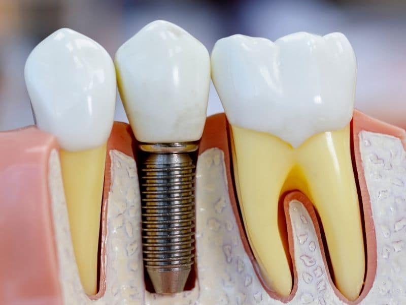 Dental implants tooth replacement